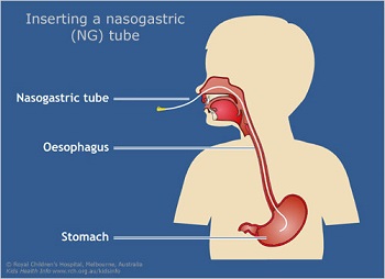 Nasogastric tube insertion